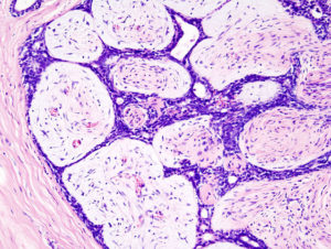 Breast-fibradenoma