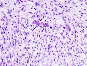 uterine leiomyosarcoma histopathology