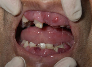 Deficiency of vitamin C can produce Scurvy. One of the main clinical manifestation is swollen gums.