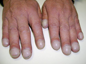 nail clubbing