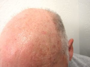 actinic keratosis on balding head