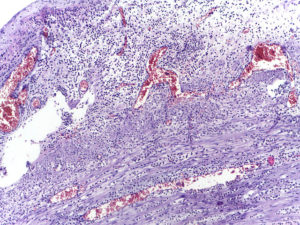 histological picture of acute inflammation
