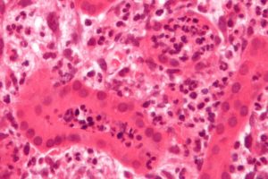 Acute pyelonephritis histopathology