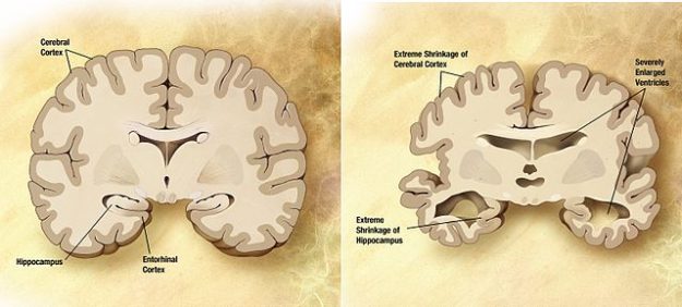 640px-alzheimers_disease_brain_comparison
