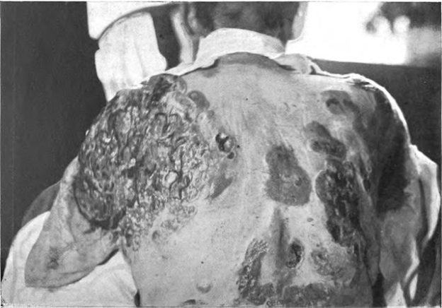 An_introduction_to_dermatology_(1905)_Mycosis_Fungoides_later_stage