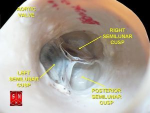 aortic valves