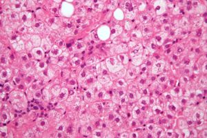 ballooning degeneration of hepatocytes in steatohepatitis