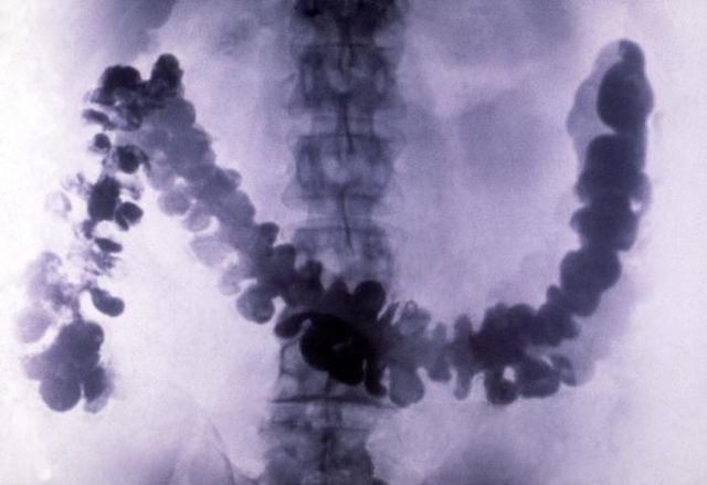 barium exposure x-ray barium exposure x-ray