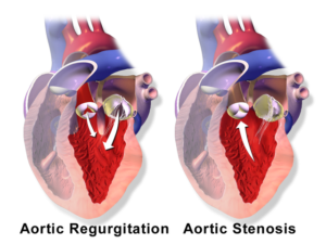 aorticvalve regurgitation and -stenosis