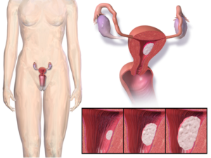 endometrial cancer