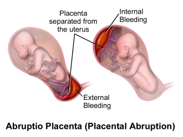 Placental Abruption.