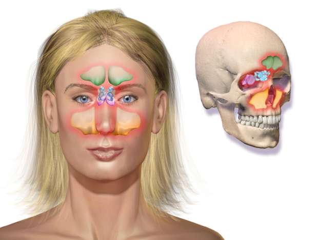 Sinusitis