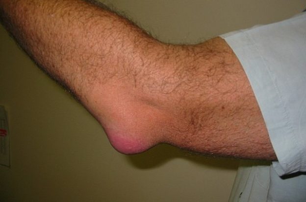 Bursitis Elbow