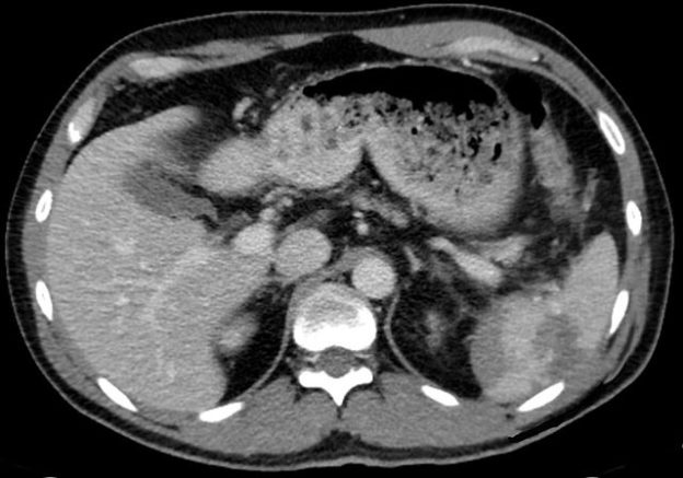 CT-Spleen-Rupture