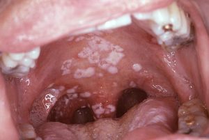 secondary oral pseudomembraneous candidiasis infection