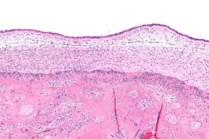 Chorioamnionitis
