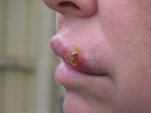 Cold sore herpes labialis