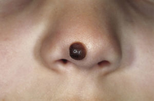 Congenital melanocytic nevus
