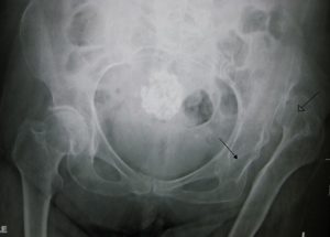 Congenital dislocation hip joint