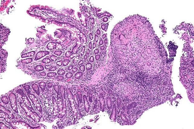 Crohn's disease - duodenum