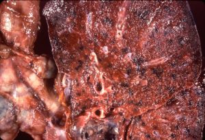 cryptococcosis gross pathology