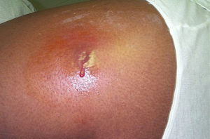 Cutaneous abscess staphylococcus aureus