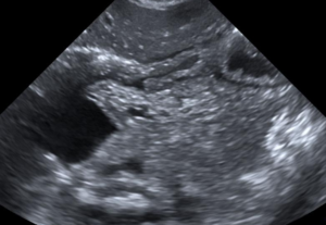 duodenal atresia ultrasonography