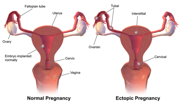 Ectopic Pregnancy dysfunctional bleeding
