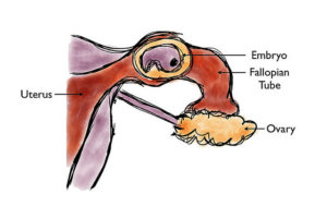 ectopic pregnancy