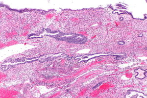 histological image of endometrial polyp with fused glands