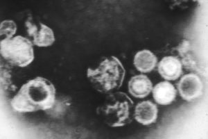 epstein-barr virus