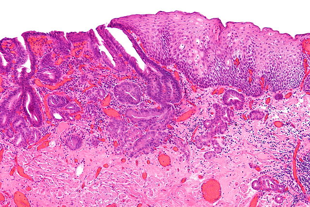 Staging Of Esophageal Cancer