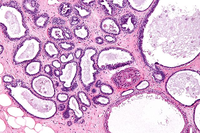 Types Of Fibrocystic Change — Findings And Treatment Lecturio