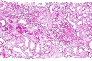 Focal segmental glomerulosclerosis