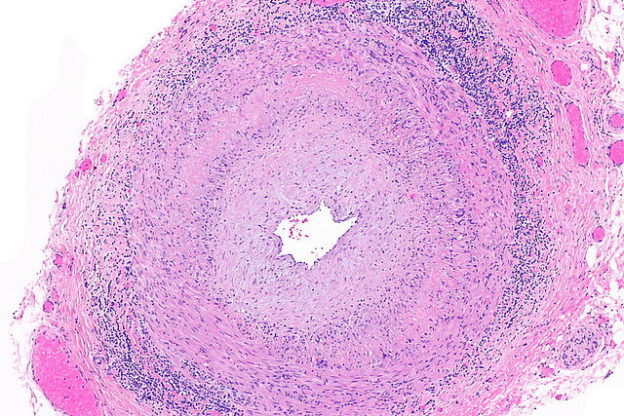 Giant cell arteritis / Temporal arteritis micrograph