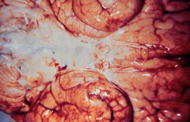 Haemophilus influenzae meningitis