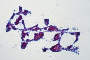 Hepatocellular carcinoma