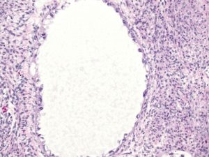 high magnification of tubulocystic clear-cell carcinoma of ovary