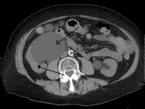 hydronephrosis