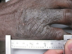 Lichen simplex chronicus plaque