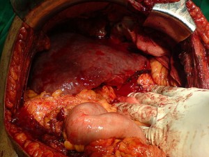 Right Subcostal Incision