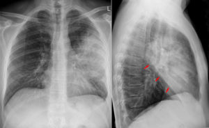 Mycoplasma Pneumonia in Children — Symptoms and Treatment