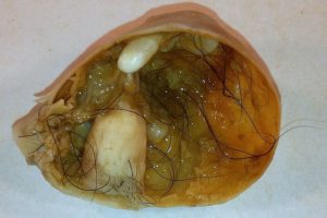 mature cystic teratoma of the ovary