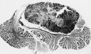 Medulloblastoma