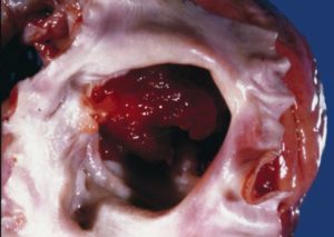 cardiac myxoma