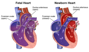 changes in newborn heart