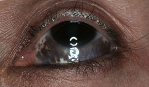 Nevus of ota