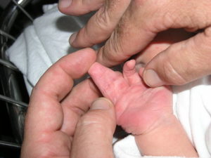new born boy showing complete complex syndactyly with two fingers right hand