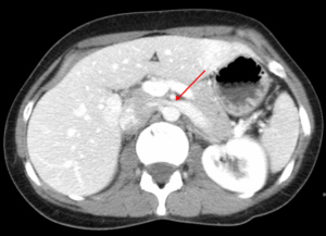 nutcracker syndrome ct scan