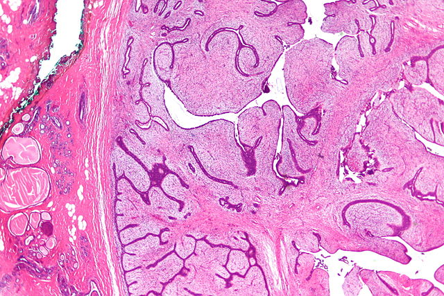 intraductalis papilloma vs fibroadenoma